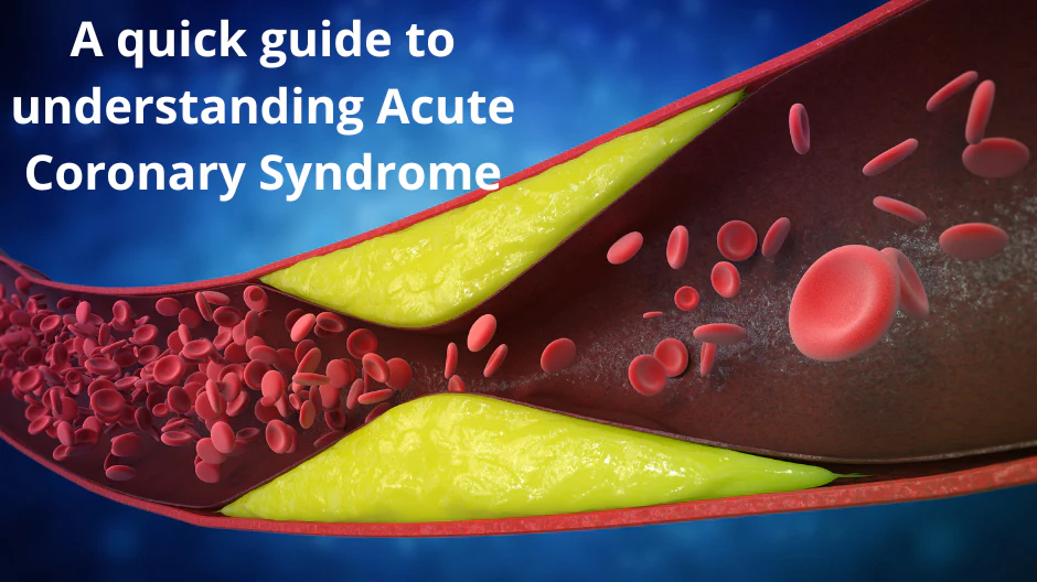 A quick guide to understanding Acute Coronary Syndrome