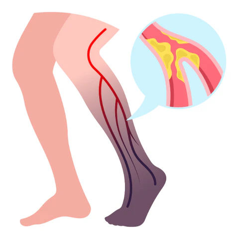 Peripheral Arterial Disease
